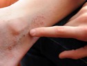 Eczema, colpisce il 6% di bambini e adolescenti nel mondo (ANSA)