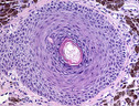 cellule tumorali (ANSA)