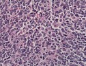 Cellule di neuroblastoma (fonte: Jensflorian da Wikipedia) (ANSA)