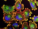 Cellule tumorali (fonte: Unsplash) (ANSA)