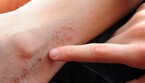 Eczema, colpisce il 6% di bambini e adolescenti nel mondo (ANSA)