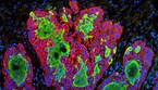 Cellule tumorali (fonte: ZEISS Microscopy da Flickr) (ANSA)