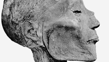 I segni del vaiolo sul volto della mummia di Ramses V (fonte: G. Elliot Smith) (ANSA)