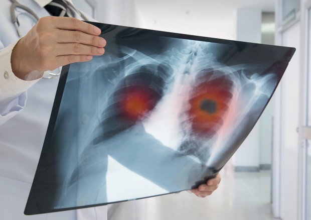 Tumore al polmone, nuova terapia per i pazienti con mutazione del gene Egfr © Ansa