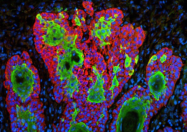 Cellule tumorali (fonte: ZEISS Microscopy da Flickr) © Ansa
