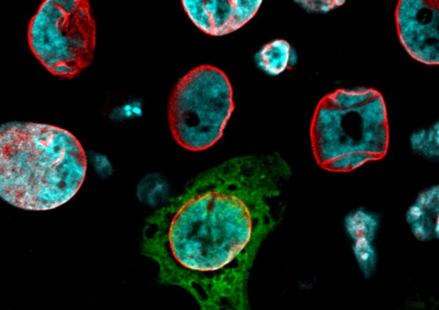 Le cellule tumorali possono passare dallo stato solido a quello liquido, più pericoloso (fonte: IFOM / Università degli Studi di Milano) © Ansa