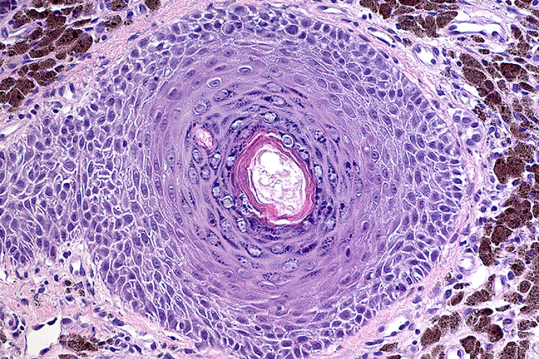 cellule tumorali -     RIPRODUZIONE RISERVATA
