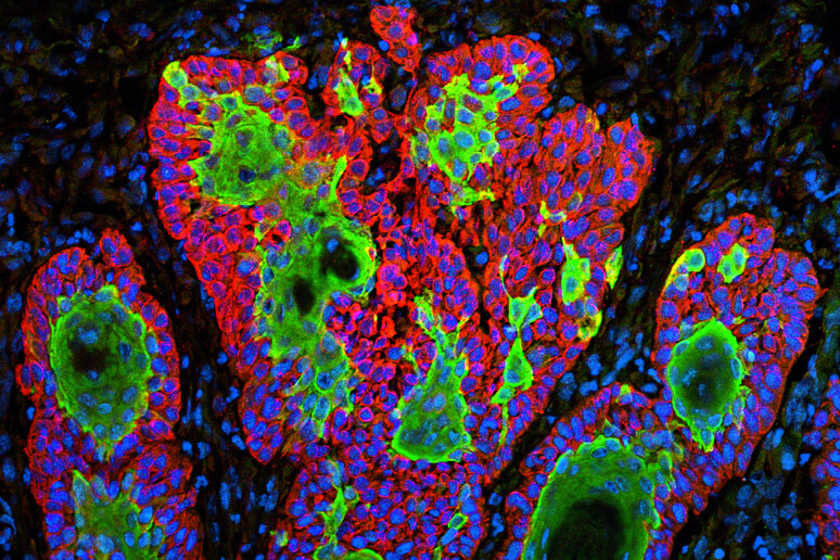 Cellule del tumore della pelle (fonte: Markus Schober e Elaine Fuchs, The Rockefeller University) - RIPRODUZIONE RISERVATA