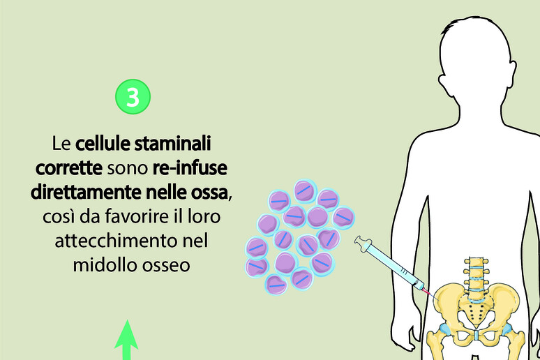 La terapia genica per la beta talassemia. infografica credit San Raffaele - RIPRODUZIONE RISERVATA