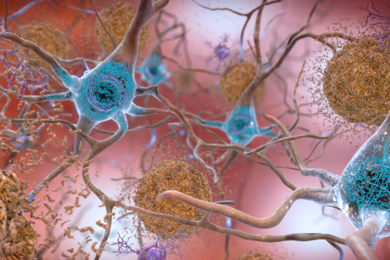 Le cellule nervose e le placche tipiche della malattia di Alzheimer (fonte: National Institute on Aging, NIH, Flickr) - RIPRODUZIONE RISERVATA