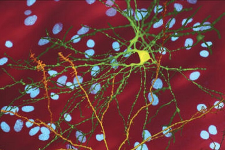 Cellule nervose colpite dalla corea di Huntington (fonte: S. Finkbeiner, Gladstone Institute of Neurological Disease, The Taube-Koret Center for Huntington 's Disease Research,UCSF) - RIPRODUZIONE RISERVATA