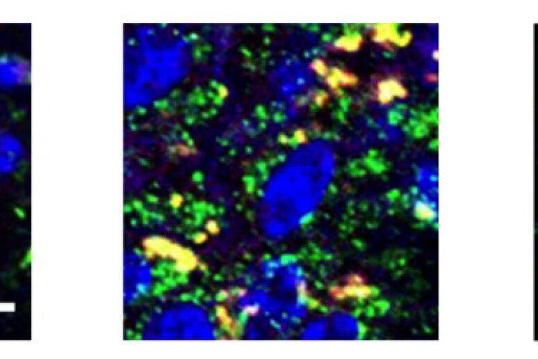 Da sinistra a destra, cellule (in blu) senza difetti di memoria, con difetti e dopo il trattamento con spermidina. In verde sono indicati i lisosomi, in giallo gli accumuli proteici. (fonte: Cnr-Ibbc e Tigem) - RIPRODUZIONE RISERVATA