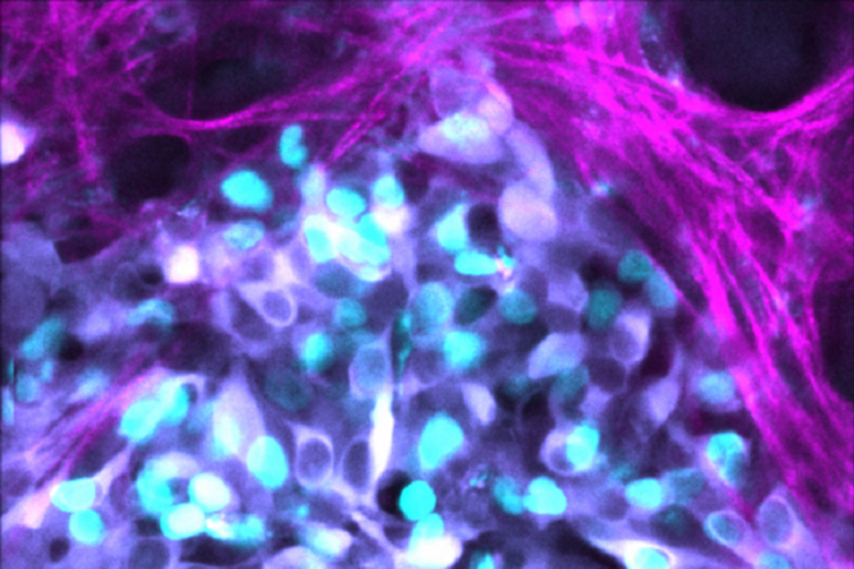 Cellule di neuroblastoma (fonte: Max Nobis / Garvan) - RIPRODUZIONE RISERVATA