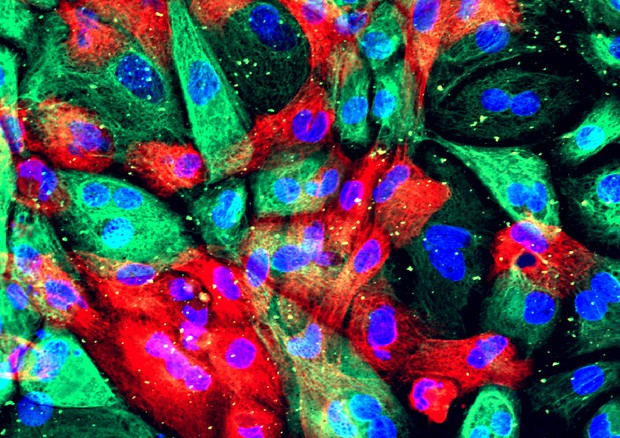 Cellule del tumore della prostata (fonte: National Institutes of Health) (ANSA)