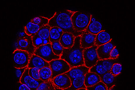 Pancreatic cancer cells (credit: Min Yu/Eli and Edythe Broad Center for Regenerative Medicine and Stem Cell Research at USC,USC Norris Comprehensive Cancer Center, Pancreatic Desmoplasia, da Flickr)